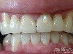 成人拔牙齿的视频大全,成人拔牙全过程视频大全