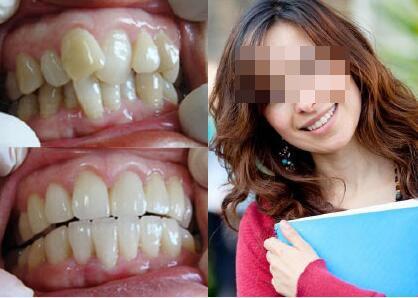 成人拔牙齿的视频大全,成人拔牙全过程视频大全  第2张